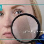 پوست خشک در تابستان