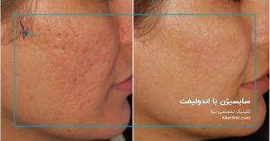 سابسیژن با اندولیفت