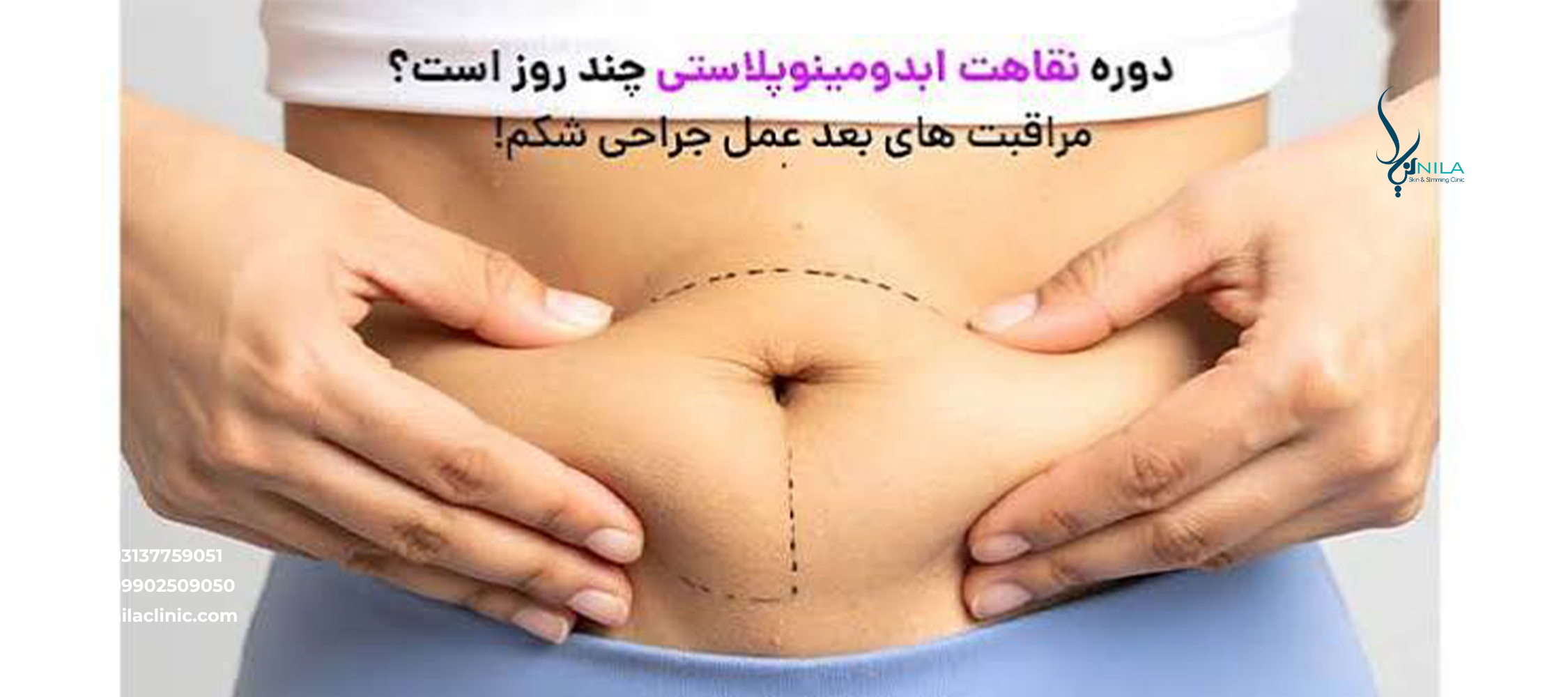 دوره نقاهت ابدومینوپلاستی