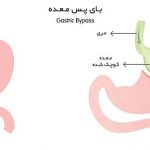 عمل بای پس معده