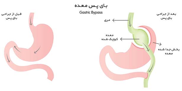 عمل بای پس معده