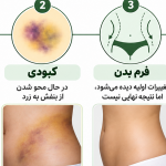 دوه نقاهت لیپوساکشن